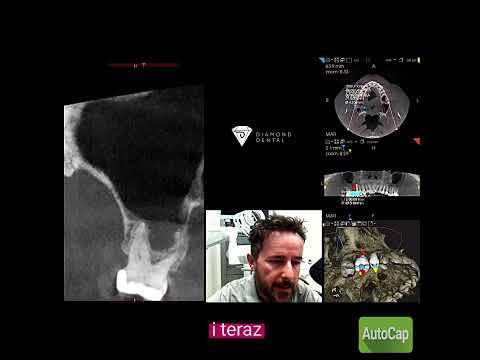 Podnoszenie dna zatoki szczękowej