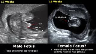 Fetal Gender Determination On Ultrasound | Determining The Sex Of A Baby On USG (Boy/Girl)