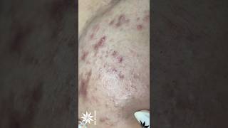 Large hidden acne under the skin .  #shortvideo #skincare #whiteheads #blackheads #acne