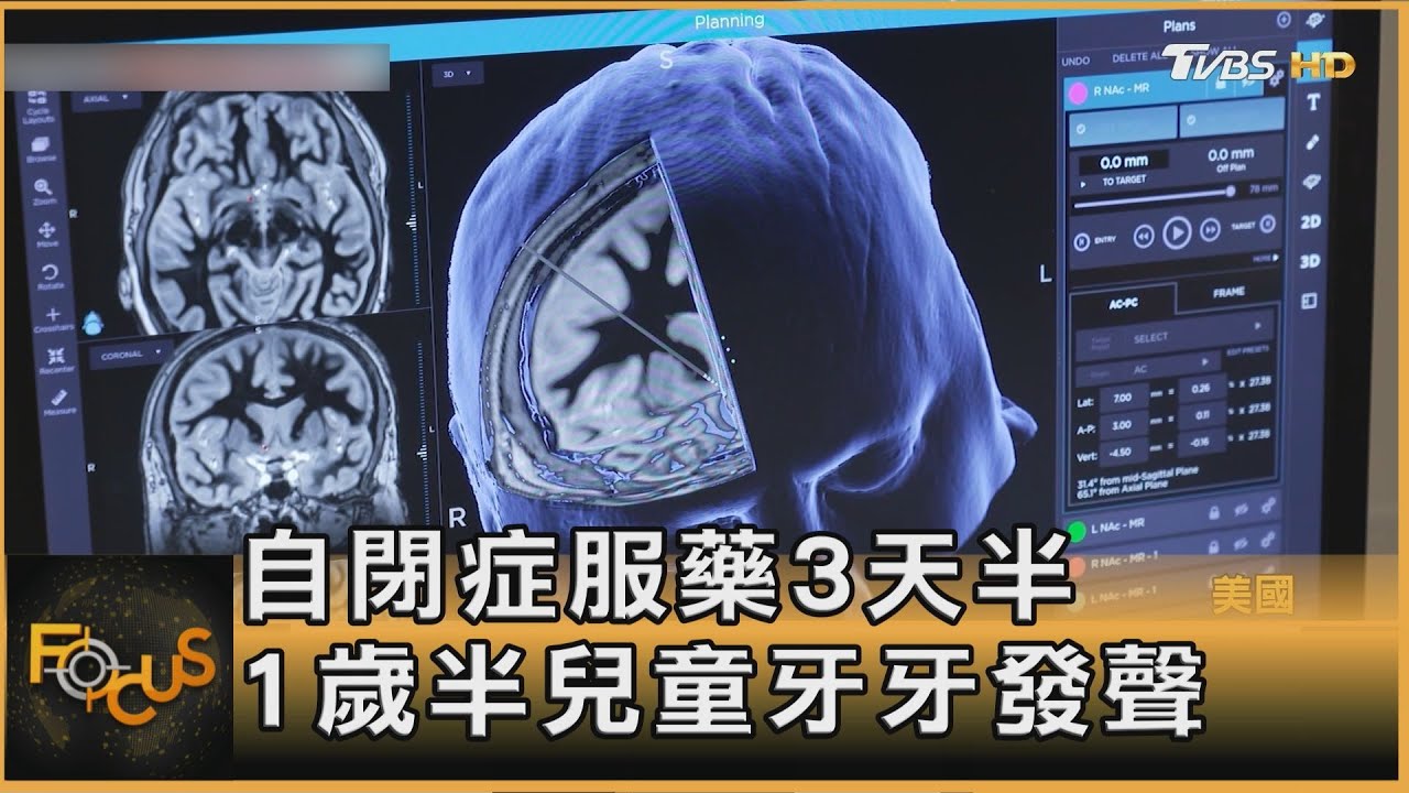自閉症服藥3天半 1歲半童牙牙發聲 走路可緩阿茲海默
