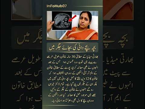 "A Medical Miracle!" – Baby Growing in Mother's Liver Instead of Womb.