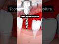 Dental Implant Process (Step by Step) #dentalimplants #dentistry