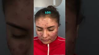 🤩 4 recomendaciones Para acné y piel grasa por dermatólogo militar 😇