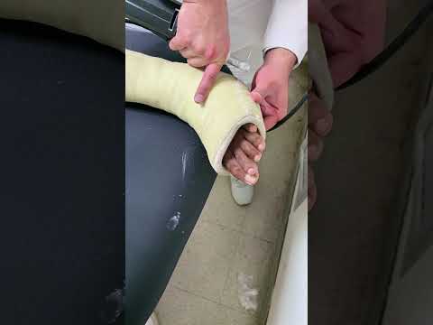 Safely Removing a Fiberglass Cast: Essential Tips for Ankle Fracture Recovery!