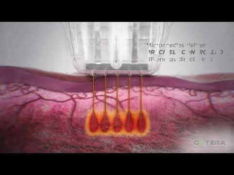 Secret RF (microneedling with radiofrequency) RFMN