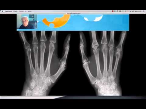 Esercizio con manubri per la colonna vertebrale toracica in osteocondrosi Cisti di Baker del ginocchio destro