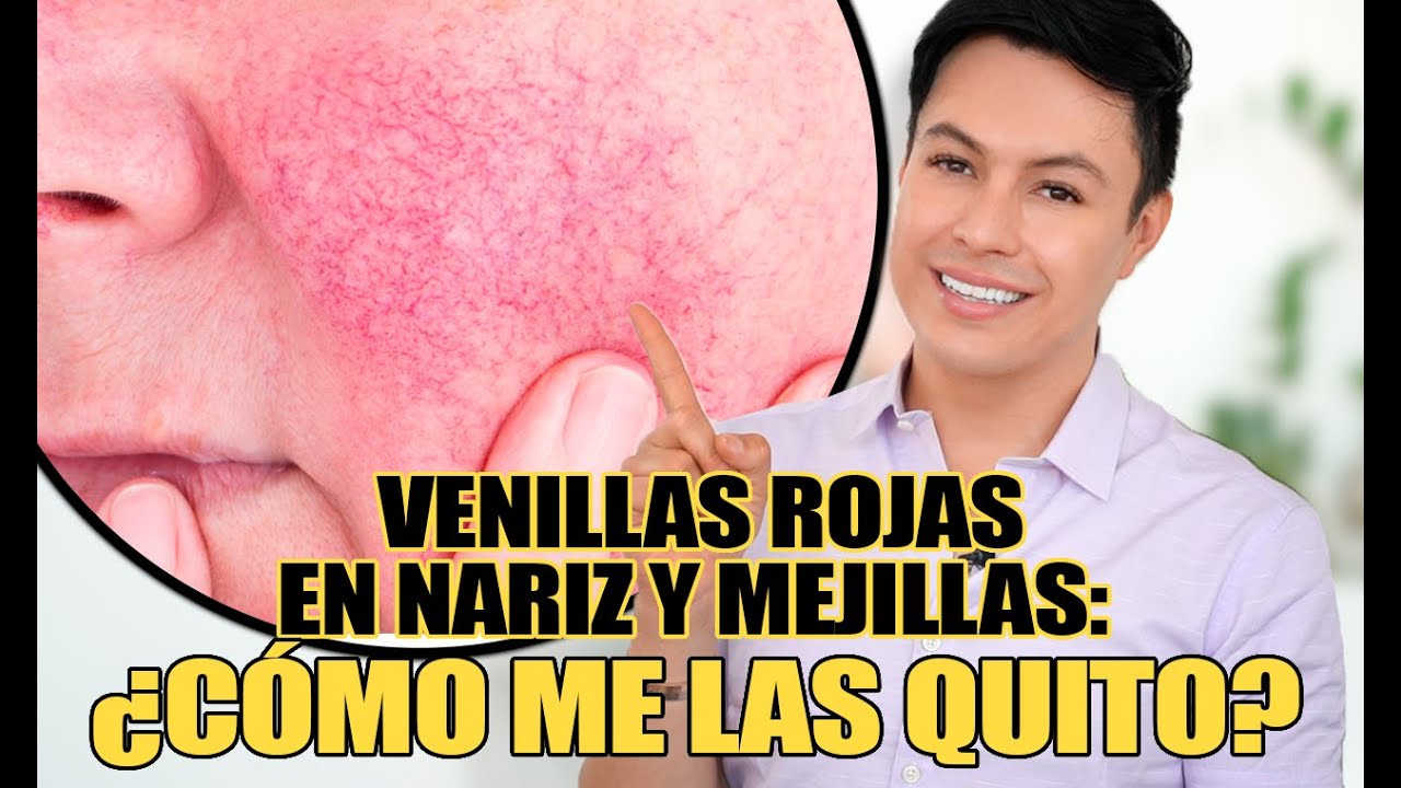 Watch Venillas rojas en la nariz y las mejillas: ¿Como Me Las Quito Now Venillas rojas en la nariz y las mejillas: ¿Como Me Las Quito