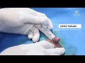 DOCTOR IS THE TECNO SEALER METHOD SAFE Dr Arif Budi S Teknoklem