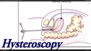 preview picture of video 'Hysteroscopy explained by Dr. Shilpa Ghosh at Bensups Hospital, Dwarka'