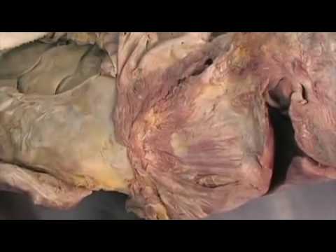 Artrosi del ginocchio e il trattamento di bardana Collo e posteriore della pressione mal di testa