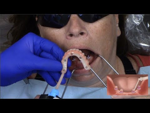 Delivery of the Completed LOCATOR F-Tx Prosthesis