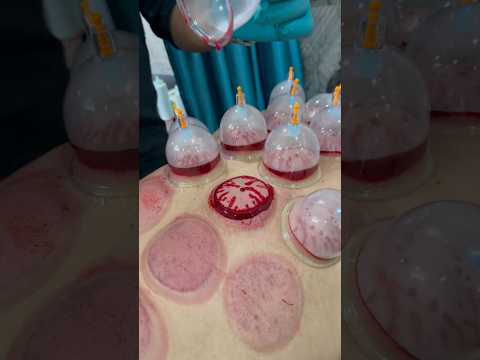 Cupping Therapy Kya Hai? 🤔 | Pain Relief 💪, Blood Circulation ❤️ & Recovery ⚡ Explained