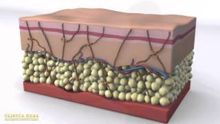 RELLENOS FACIALES CON ACIDO HIALURONICO Y RADIESSE EN VALENCIA