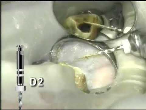 Retreatment using ProTaper® Universal Retreatment Files | Dentsply Sirona