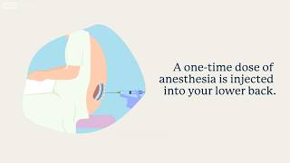 Managing Pain During a Cesarean Birth | UCLA Health BirthPlace