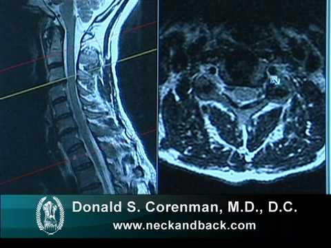 Vorsprung der Hals und die Brust Osteochondrose Wie hip Blockade machen