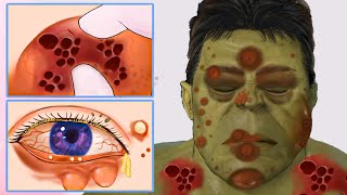 ASMR Get Rid of Bee Stings and Pimples | Pimple Clearing Animation