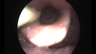 Product video: Passy Muir Tracheostomy, Ventilator Swallowing & Speaking Valves