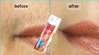 DON&#39;T SHAVE REMOVE UPPER LIP HAIR IN 5 MINUTES USE TOOTHPASTE PERMANENT RESULT
