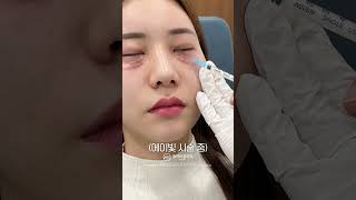 피부 상태별 맞춤 시술 과정