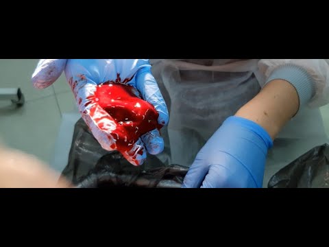 Intravaginal Hirudotherapy: Leech Therapy | Gynecological | Hirudo.Clinic #leechtherapy  #Gynecology