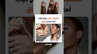 المرض لا يدمّر الخلايا الصبغية!.. اكتشاف علمي يفتح الباب أمام علاج البهاق thumbnail