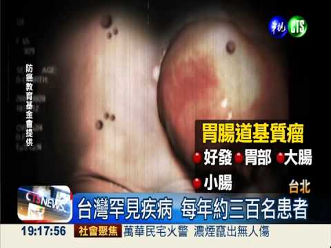 腹痛腫脹還血便 罹胃腸道基質瘤