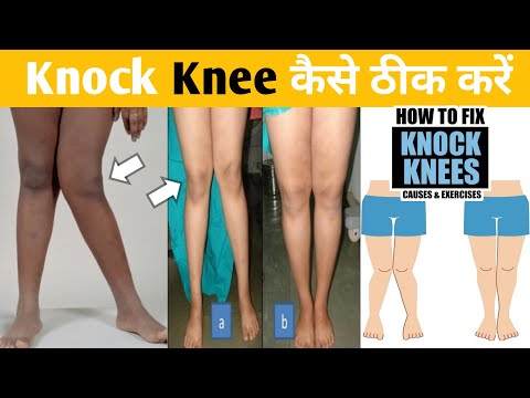 Knock knee problem solution, genu valgum correction exercises, genu varum,knock knee kaise thik kare