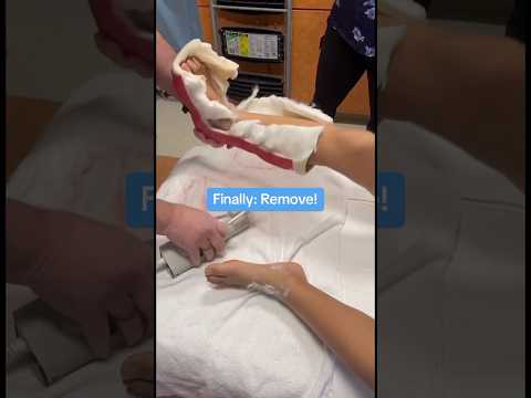 Removing a cast in 4 easy steps! | Boston Children's Hospital #castsaw #shorts