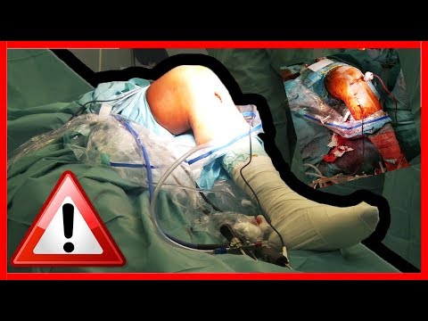 Artrita hemoragică a genunchiului