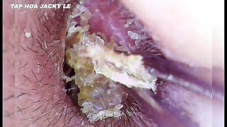 Ear Wax Removal #57: It Feels Very Good When A Lot Of Earwax Is Removed | Ear Cleaning ASMR