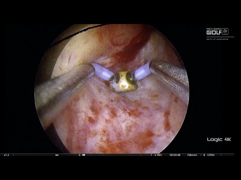 STEP 2_LATERAL INCISIONS - BIPOLAR ENDOSCOPIC ENUCLEATION...