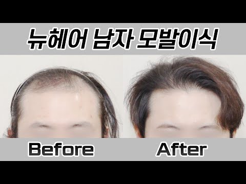 남자 모발이식 2000모낭(4000모) 360일 경과 I 뉴헤어 I Before&After [모발이식][모발이식수술]