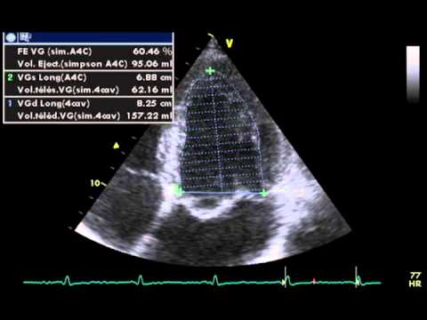 ACCURATE MEASUREMENT OF LVEF  (left ventricular ejection fraction) by biplane simpson's method