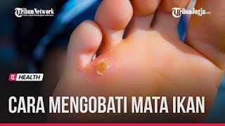 Download lagu CARA ALAMI MENGOBATI DAN MENYEMBUHKAN MATA IKAN mp3 Download lagu CARA ALAMI MENGOBATI DAN MENYEMBUHKAN MATA IKAN mp3