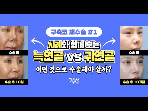 #구축코수술 귀연골 VS 늑연골 어떤 것으로 수술해야 하나요❓