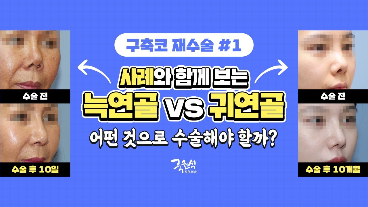 #구축코수술 귀연골 VS 늑연골 어떤 것으로 수술해야 하나요❓ 썸네일