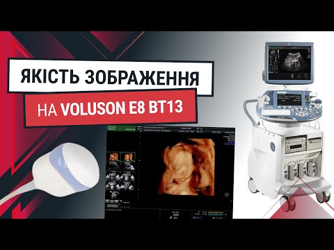 Деталізований скринінг GE Voluson E8 BT13 - Статті RH