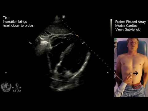 Subxiphoid View - Transthoracic Ultrasound (Echocardiography)