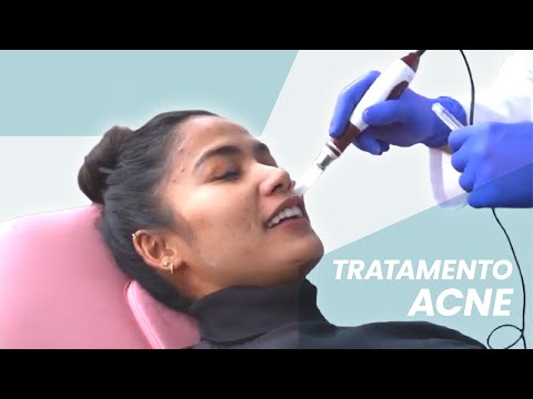 Tratamento Acne com Ann Colis