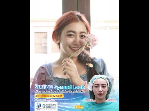 รีวิวหัตถการโปรแกรมร้อยไหม Spread Lock