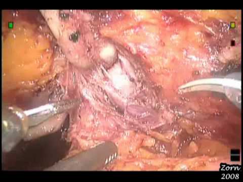 Robotic Radical Prostatectomy - STEP 1-  Posterior Dissection