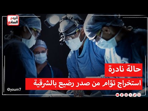 حالة نادرة تحدث كل 2 مليون طفل ..  تفاصيل استخراج توأم من صدر رضيع بالشرقية