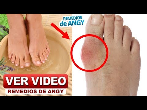 6 de los mejores remedios caseros para juanetes