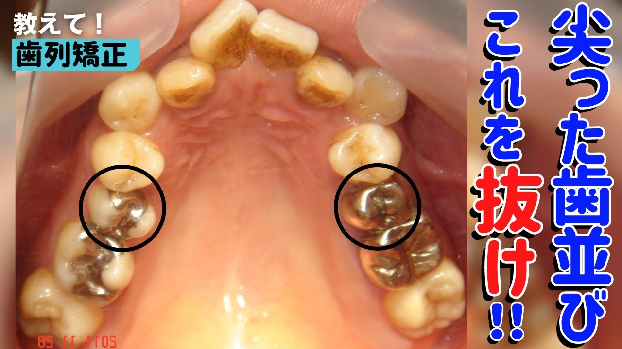 【歯列矯正】顎が狭くて歯が収まりません！