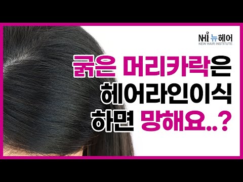 굵은 모발은 헤어라인교정하면 망하나요..? 뉴헤어 [헤어라인][헤어라인교정]