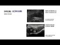 Iliopsoas Tendinopathy Explained | Anterior Hip Pain Causes, Diagnosis & Treatment