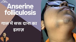 Anserine folliculosis | rough skin on chin , cheek / गाल में सक्त दाना का इलाज़ / Dr Uttam Lenka