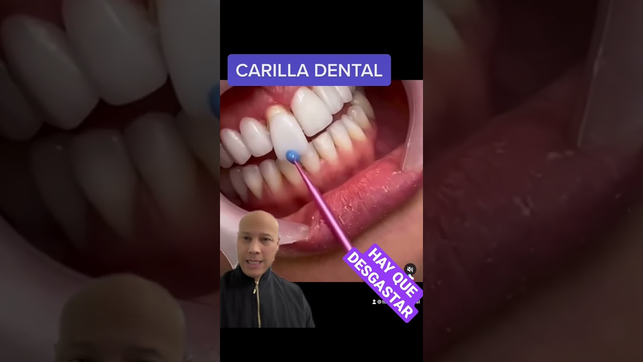 EL PEOR ERROR DE LAS CARILLAS DENTALES