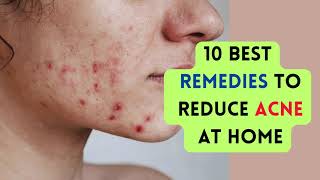 10 Best Remedies To Reduce Acne At Home / Acne treatment / Acne scars home remedies / viral / remedy